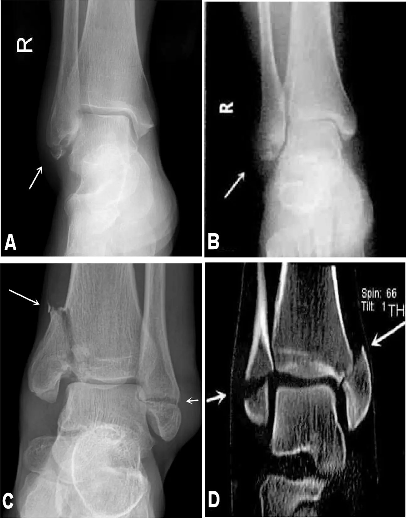 Ankle fracture case 1
