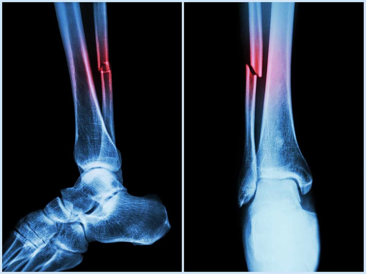 Ankle fracture case 2