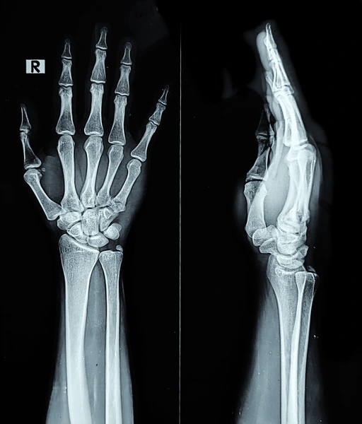 Wrist fracture case 2