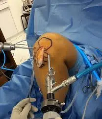 Ligament surgery case 1